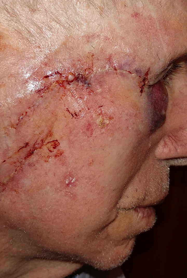 Dad's face after surgery