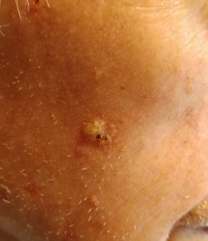 Skin cancer on Dad's cheek